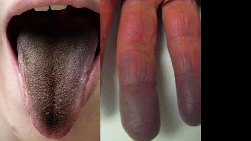 Língua peluda e dedo roxo: saiba mais sobre os novos sintomas da Covid ...